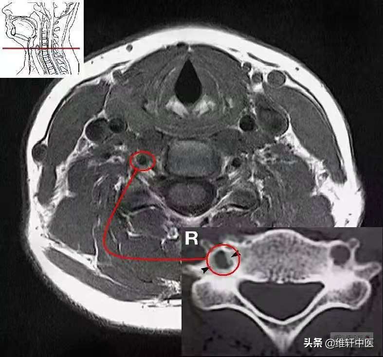 王氏中医导引踩跷法治疗“脑雾”现象
