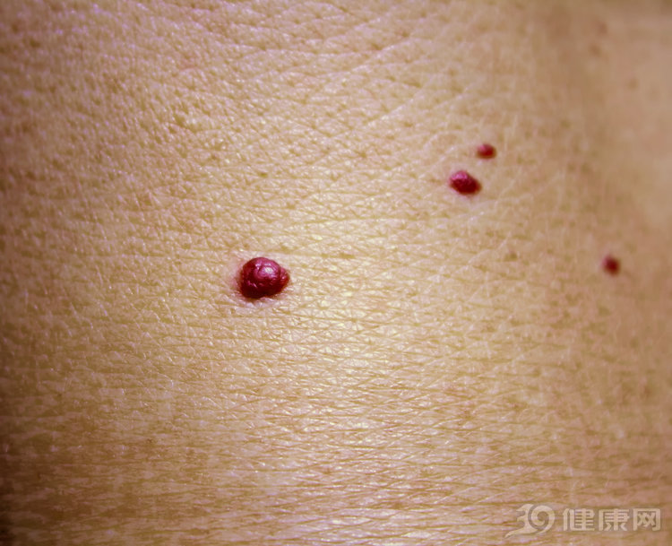 身上有红痣是肝病的前兆吗,皮肤上长红痣要当心是肝病的征兆