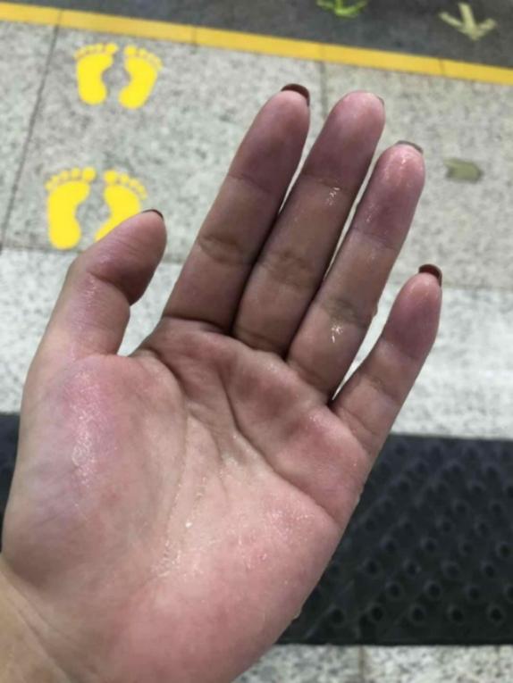 让青春不留遗憾，致手汗症青年朋友！