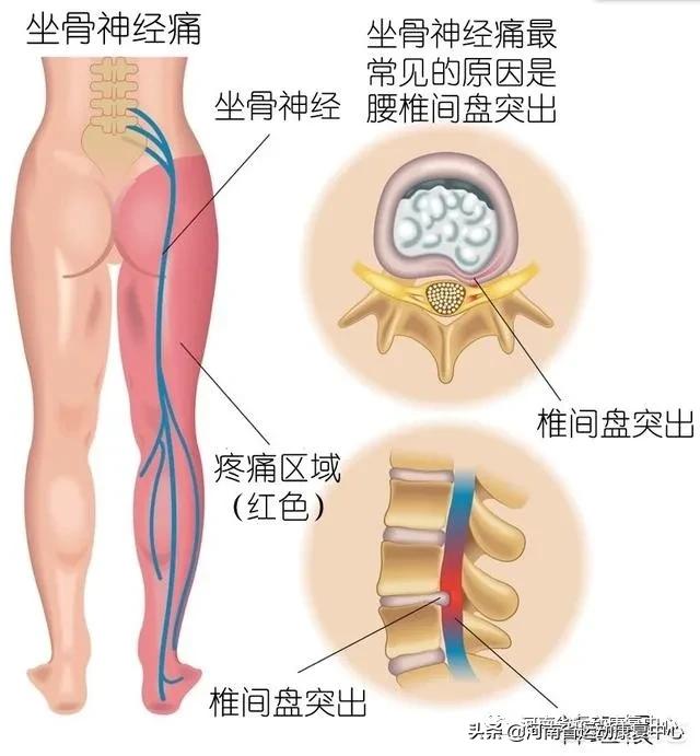 腰椎间盘突出正确锻炼方法,腰椎间盘突出吃什么药有效