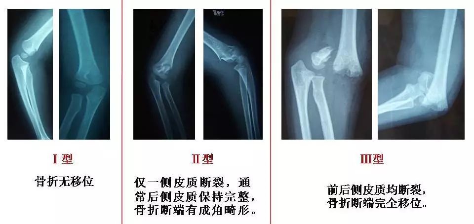 小孩胳膊骨折的治疗方法,胳膊骨折后骨折处发热怎么回事