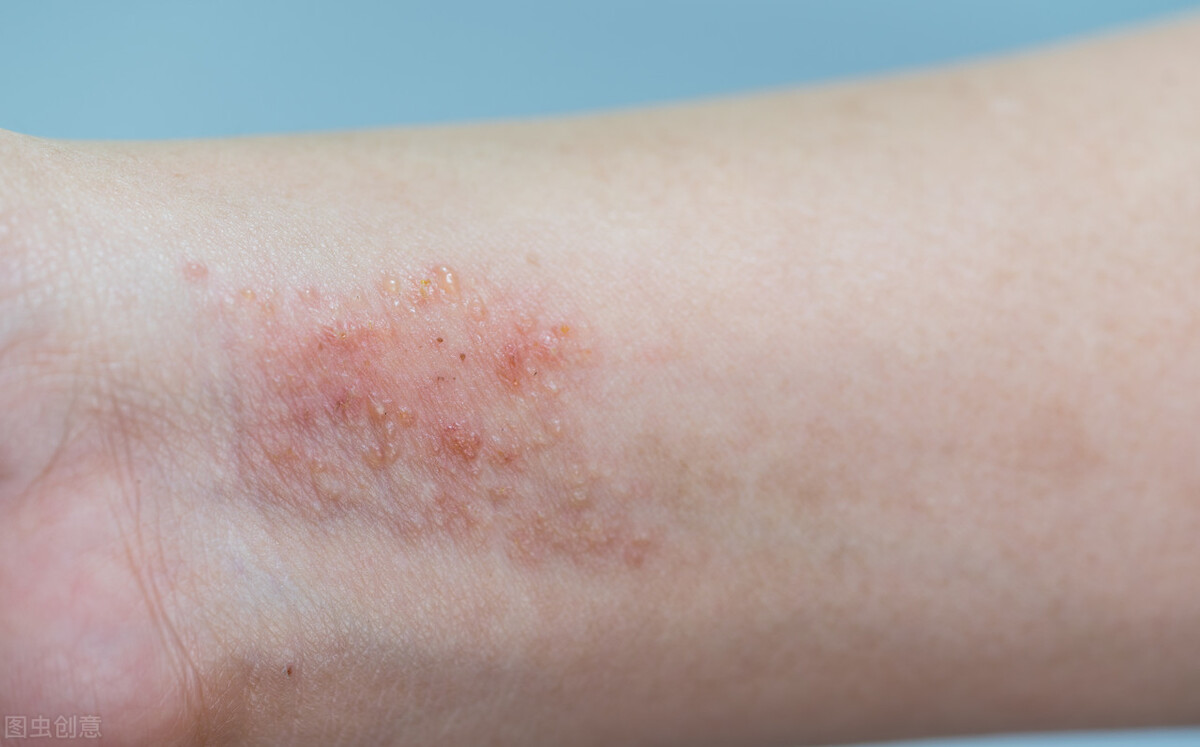 湿疹一直好不了怎么回事,手指慢性湿疹总是好不了
