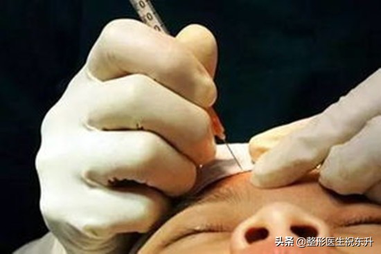 眉间纹很淡打肉毒素打多少,眉间有纹打肉毒素能消除吗