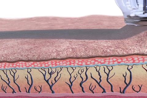 痘印反反复复怎么办,痘印一直反反复复怎么办