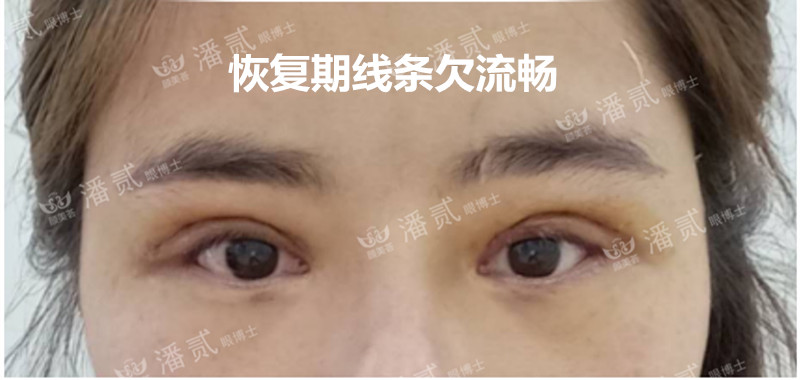 高难度修复双眼皮宽改窄恢复期,高难度双眼皮修复案例