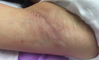 腋臭特效药一览表,miradry微波腋臭手术哪里可以做