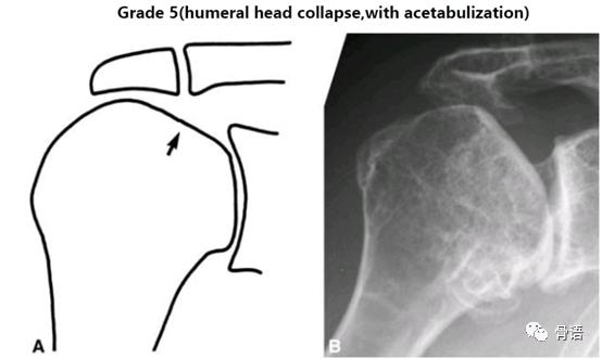 巨大肩袖撕裂概念图,右肩袖巨大撕裂