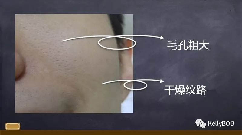 你的肌肤正处于慢性过敏？因为过度护肤！如何正确的护肤！