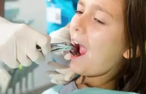 拔牙后血窟窿怎么清洁,拔牙后的血窟窿
