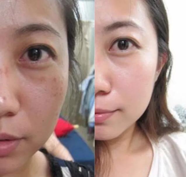 点阵激光祛痘印的副作用和危害,做点阵激光手术有什么危害