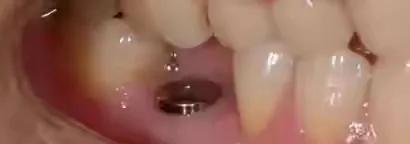 种植牙手术流程图解,口腔种植牙护士手术配台流程