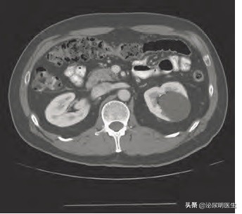 多发肾囊肿和多囊肾有什么区别,多囊肾跟多发肾囊肿有什么区别