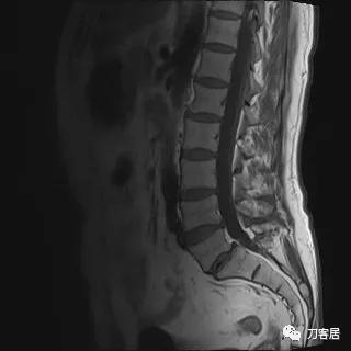 小针刀扎到坐骨神经会瘫痪吗,小针刀会切断坐骨神经吗