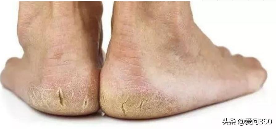 中老年人脚后跟开裂，大多是这些原因造成的，5个方法可改善