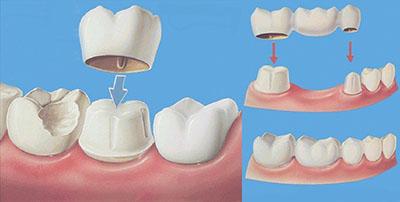 科普知识种植牙和烤瓷牙要怎么选,浦东新区烤瓷牙和种植牙哪种好