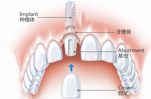 种植牙打钉子要恢复多久才能种植,一口种植牙需要几个钢钉
