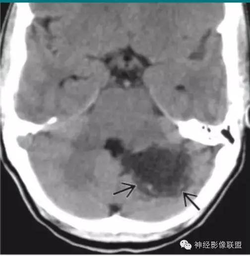 各种囊肿的症状,颅内囊肿18-19mm严重吗