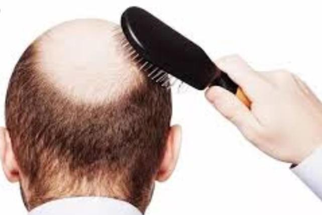 秃顶福音？世界首家头发银行开业：冷冻头发，若秃顶可取回生发