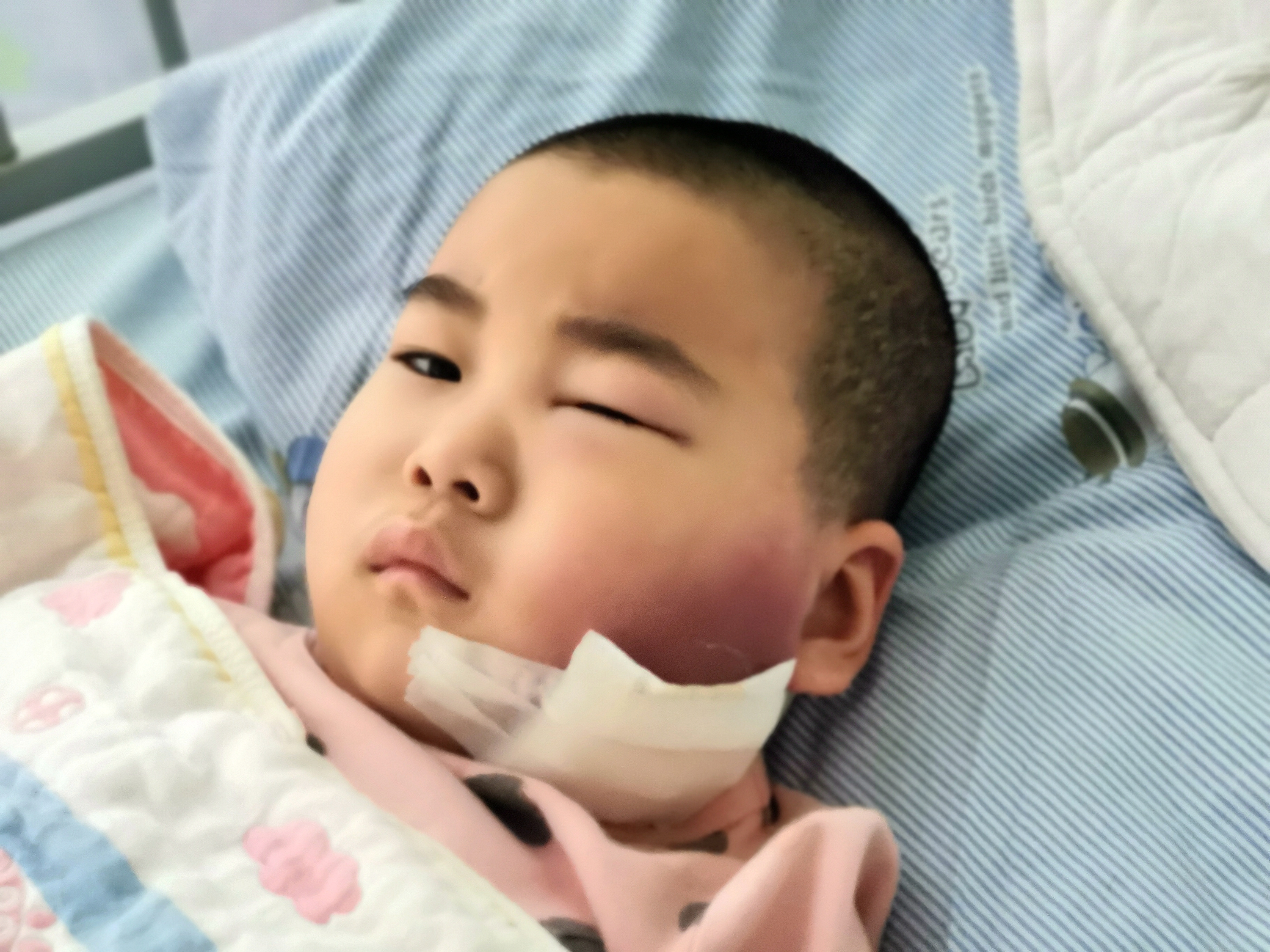 湖北4岁女孩生病致脸部毁容，需“割肉”治疗，爸爸门外放声大哭