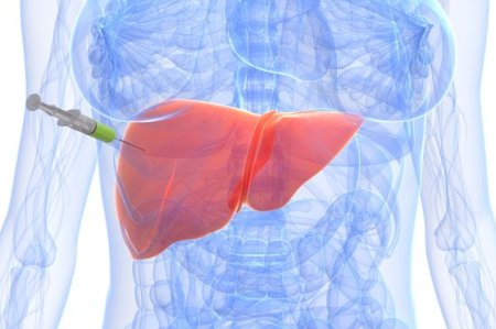 乙肝病人转氨酶高对肝有什么影响,慢性乙肝引起转氨酶高200