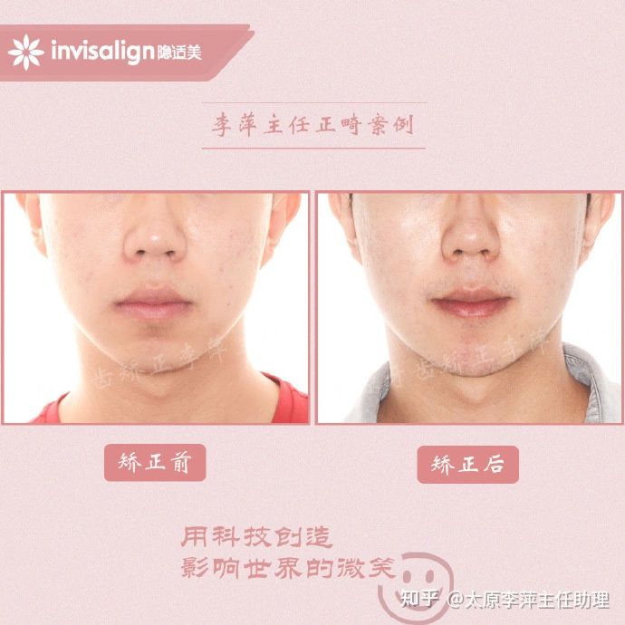 太原矫正牙齿需要做正颌吗,太原牙齿二次矫正