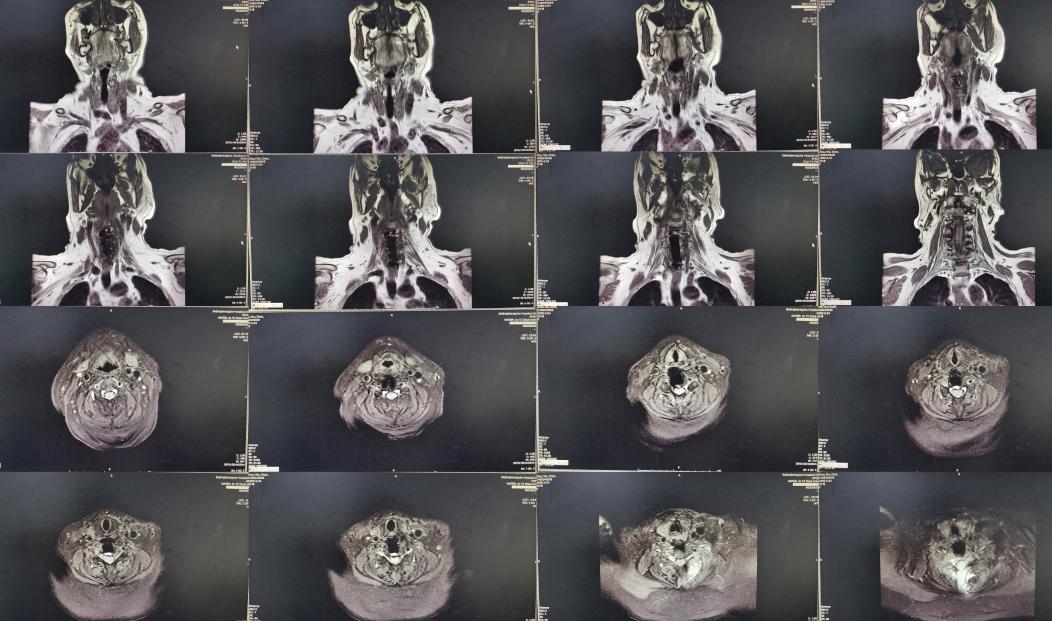 颈椎术后脑脊液漏取什么体位,脊髓型颈椎病手术后植骨愈合时间