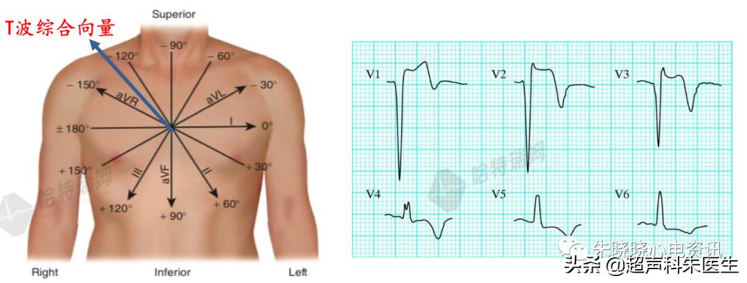 t波倒置9个真相图解,t波倒置判断口诀