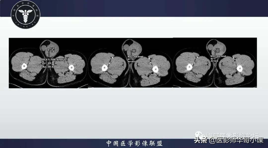 [精品课件]畸胎瘤及精原细胞瘤（*丸睾**肿瘤及肿瘤样变CT及MR表现）