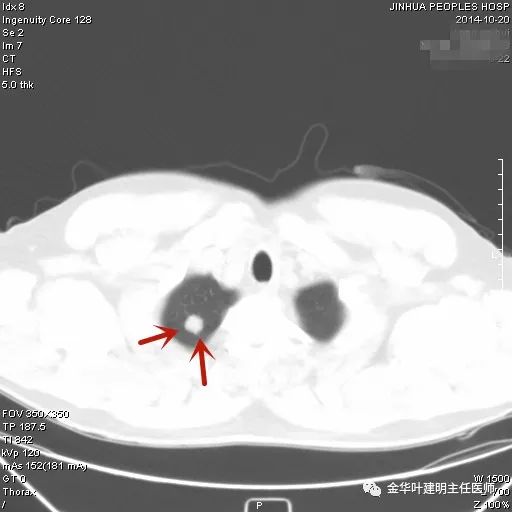 叶建明谈实性结节,叶建明肺实性良性结节会变癌症吗