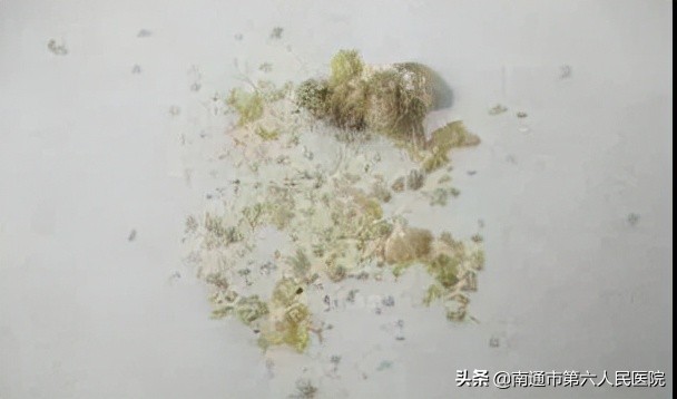 肾结石体外震波碎石治疗费用多少,肾结石在什么位置不能用体外碎石