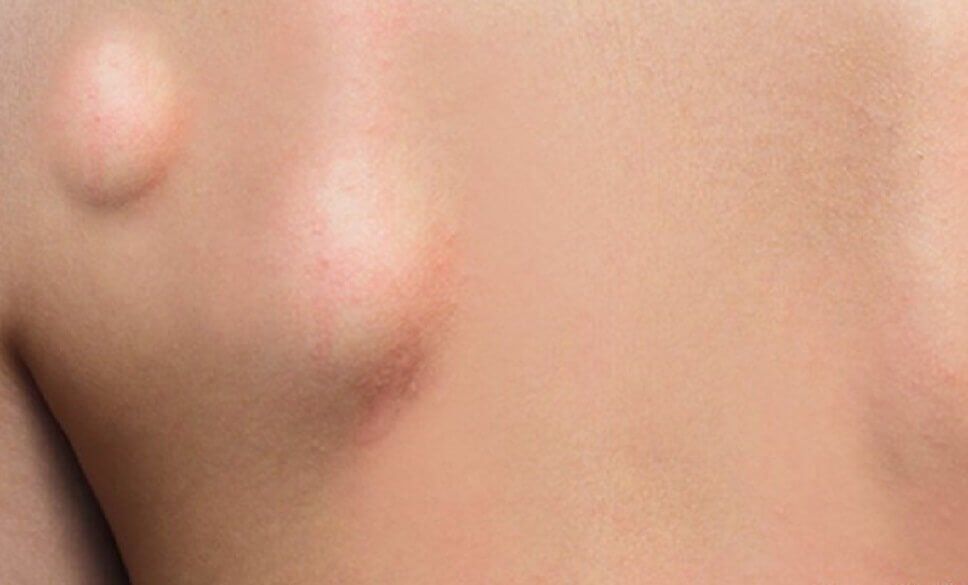 脂肪肉瘤和脂肪瘤怎么分辨,脂肪瘤很常见吗