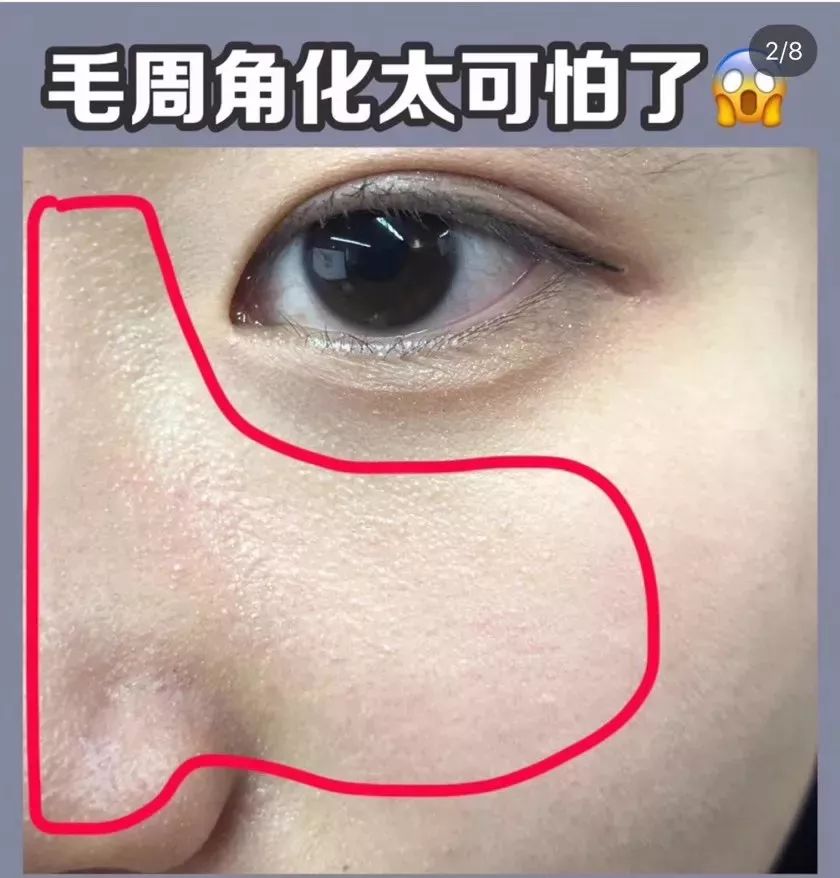 下巴挤出小米粒样的东西,下巴闭口挤出来的东西臭