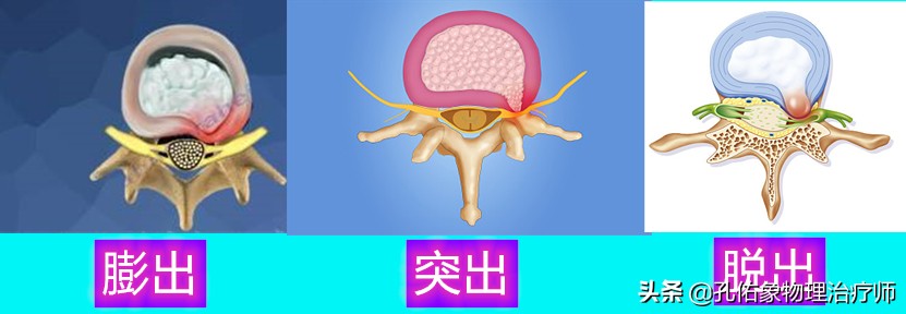 腰椎间盘膨出最佳消除方法是什么,有腰椎间盘突出不知该怎么治疗