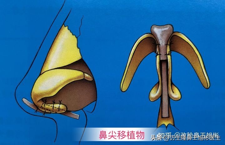 又想鼻子高又不想做鼻子怎么办,怎么让鼻尖变得又高又挺