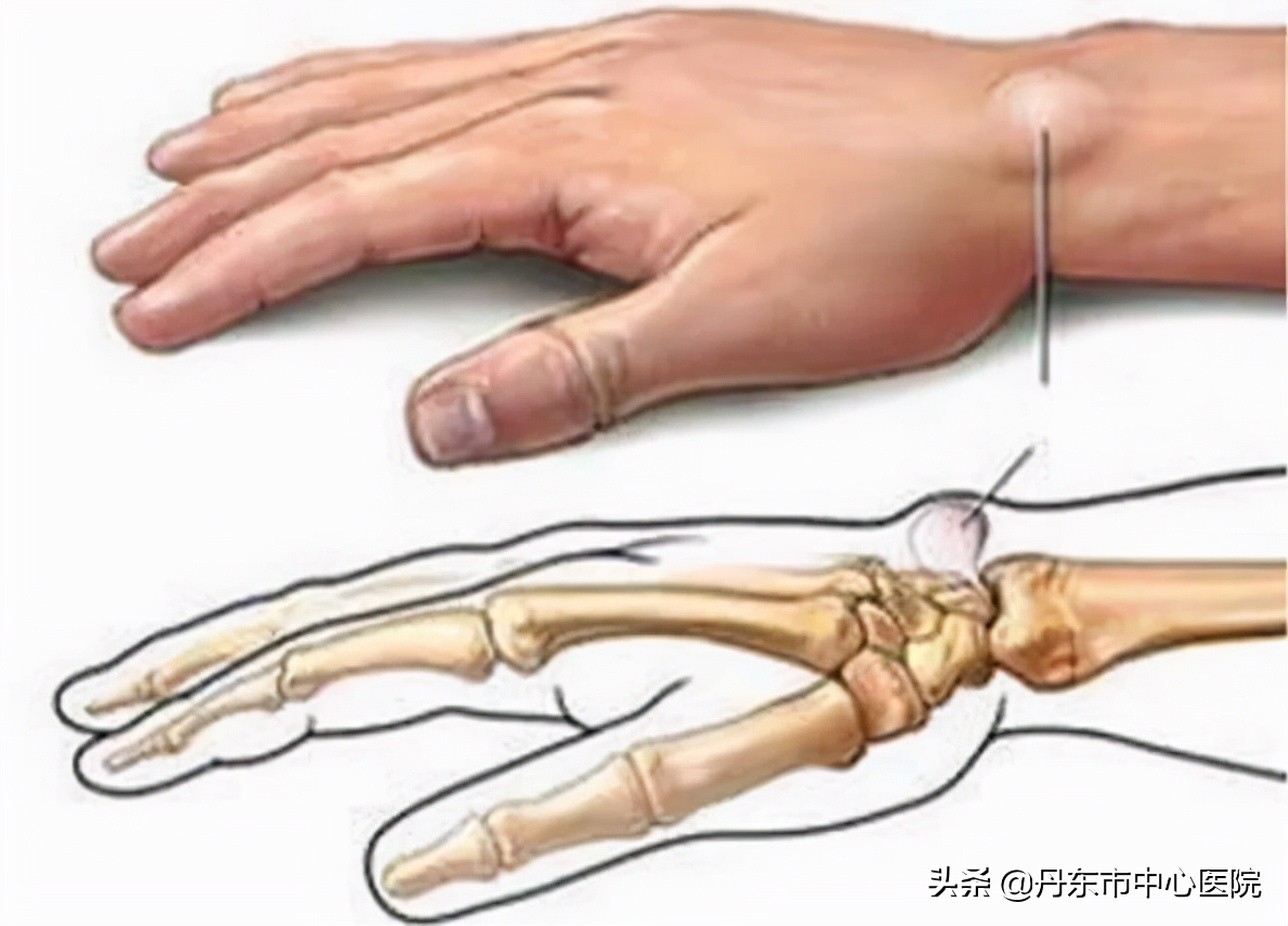 医学科普腱鞘囊肿骨科,健康科普知识大全骨科