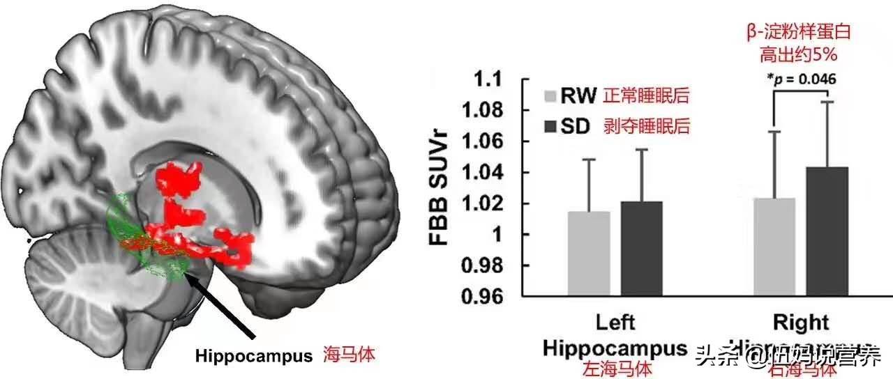 苏大强阿尔茨海默症症状,苏大强得了阿尔茨海默症