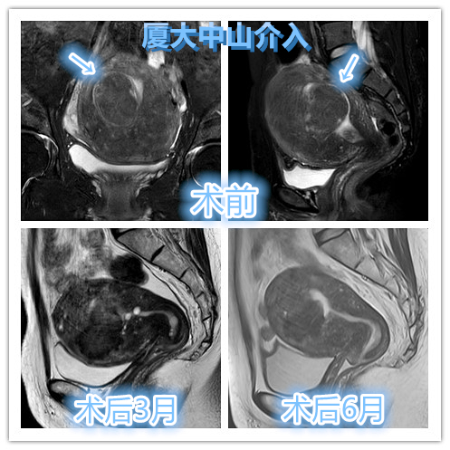 哪些子宫肌瘤介入栓塞后容易从阴道排出？