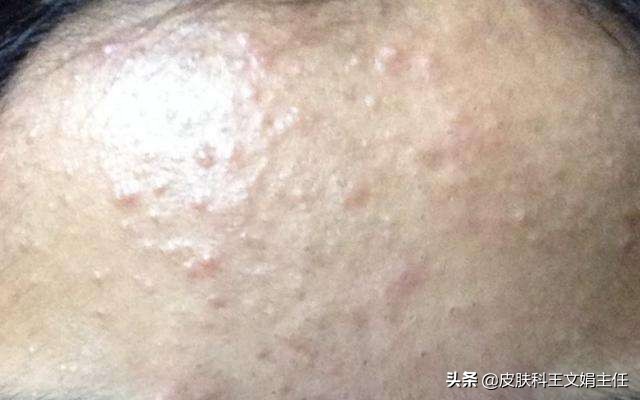 夏季常见皮肤病及用药,应对夏季常见皮肤病的小妙招