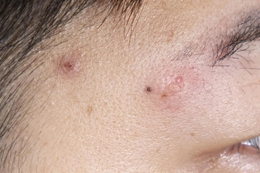 让无数姑娘无从下手的痘印，皮肤科医生有了解决新招