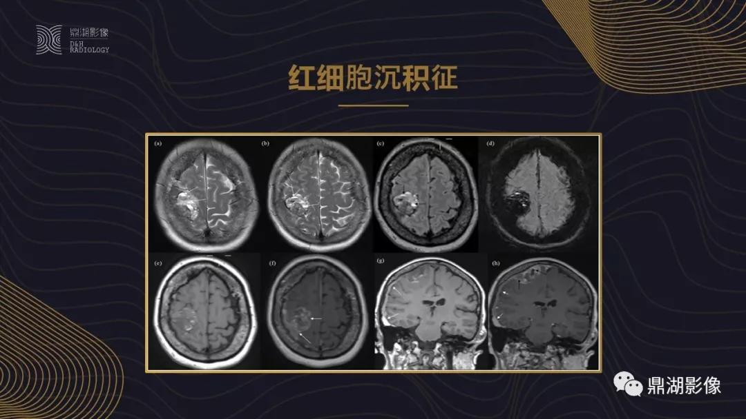 不简单|脑出血超详细学习笔记