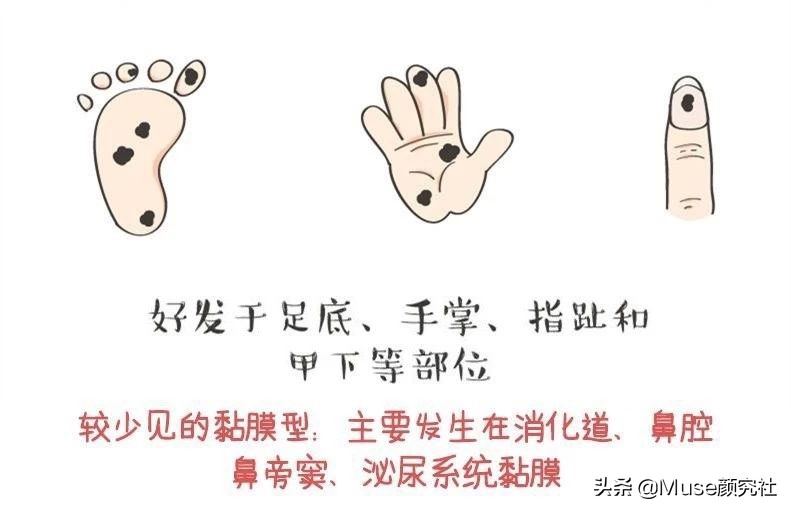 脸上长痦子是有福吗,脸上很容易长痣是什么原因