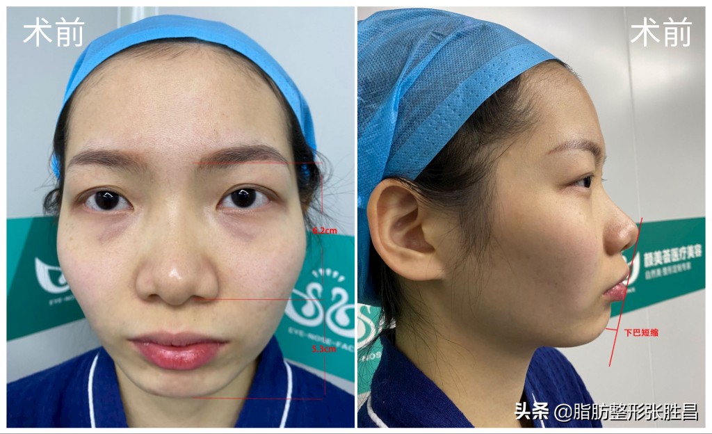 下巴后缩但不想脸变长,下巴后缩不想正颌只想整齐