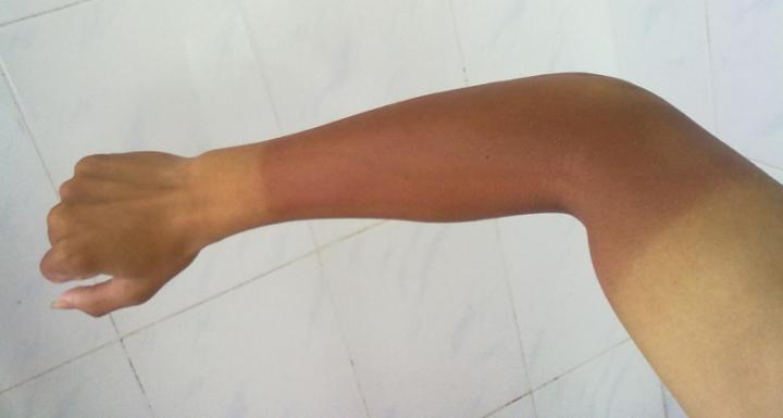 脖子被太阳晒黑了怎么才能变白,被太阳晒黑怎样变白女生