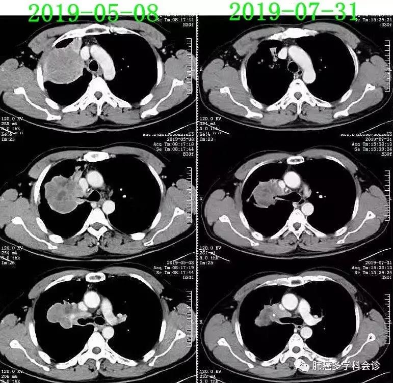 上海专家肿瘤治疗新探索,肿瘤诊疗一体化治疗方案