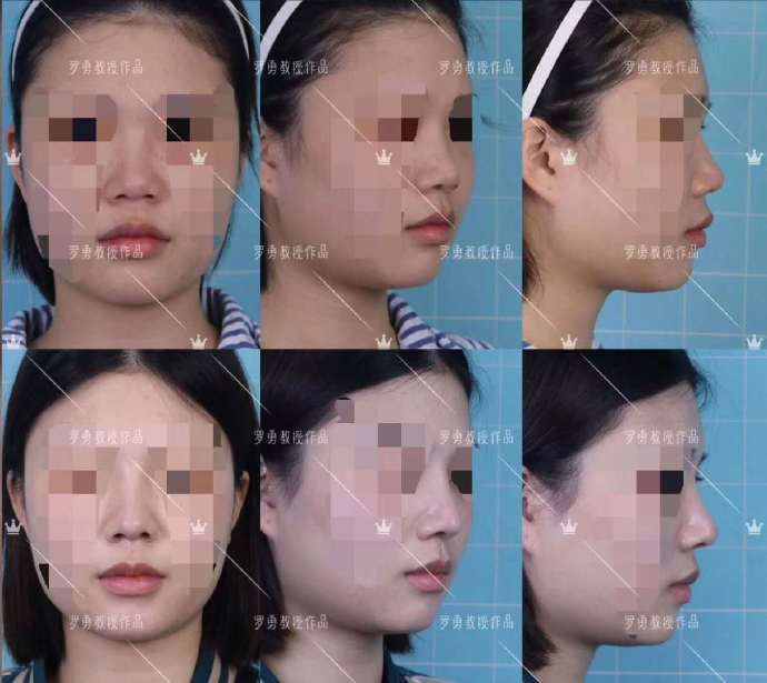 哪四种鼻子最不好看,宽鼻子好看还是窄鼻子好看