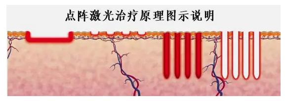 点阵激光祛痘印的副作用和危害,做点阵激光手术有什么危害