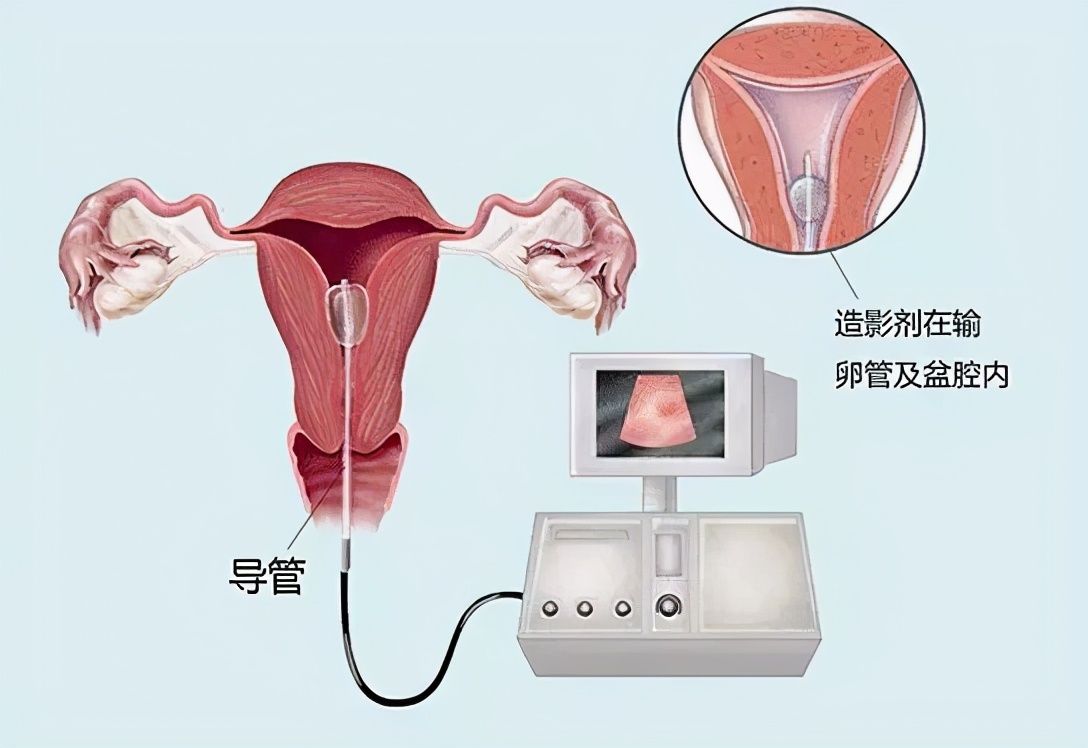 子宫输卵管造影全过程,碘海醇子宫输卵管造影