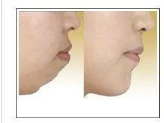 小儿鼾症的表现不包括,小儿鼾症是什么