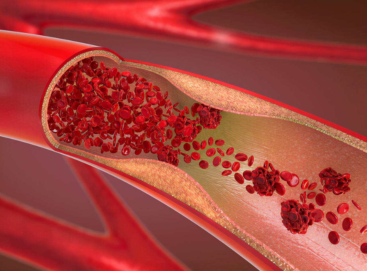 高血脂应该吃什么食物来控制血脂,血脂偏高吃米饭好还是吃面条好