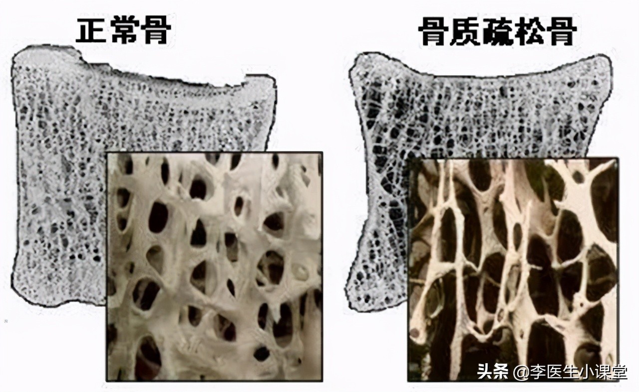 更年期骨质疏松吃什么药止疼好,骨质疏松胳膊疼痛吃什么药止疼
